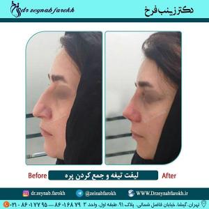 لیفت تیغه و  جمع کردن پره بینی 311