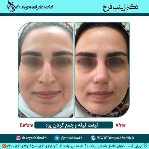 لیفت تیغه و  جمع کردن پره بینی 314