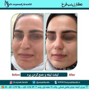 لیفت تیغه و  جمع کردن پره بینی 315
