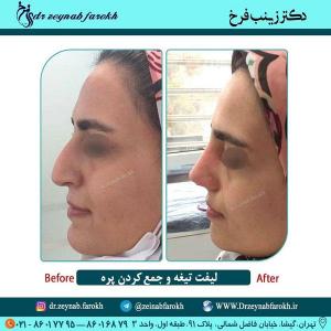 لیفت تیغه و  جمع کردن پره بینی 316