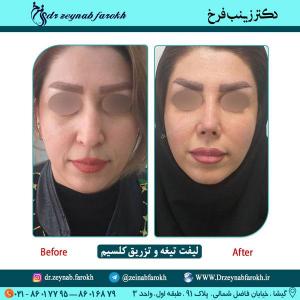 لیفت تیغه و تزریق کلسیم 31