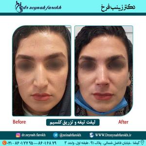 لیفت تیغه و تزریق کلسیم 33
