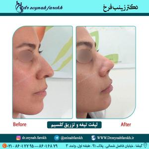 لیفت تیغه و تزریق کلسیم 36