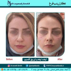 لیفت تیغه و تزریق کلسیم 37