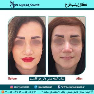 لیفت تیغه و تزریق کلسیم 41