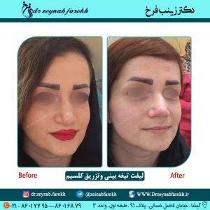 لیفت تیغه و تزریق کلسیم 43