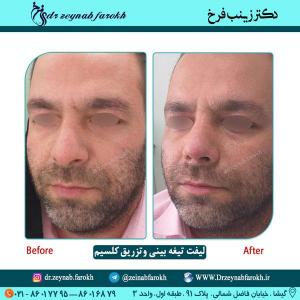 لیفت تیغه و تزریق کلسیم 51