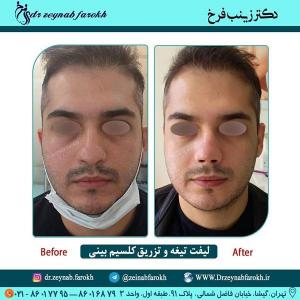 لیفت تیغه و تزریق کلسیم بینی 264
