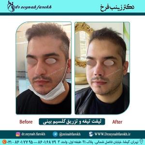 لیفت تیغه و تزریق کلسیم بینی 265