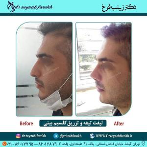 لیفت تیغه و تزریق کلسیم بینی 266