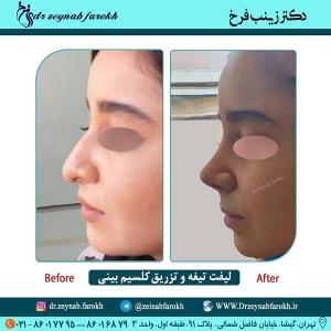 لیفت تیغه و تزریق کلسیم بینی 269