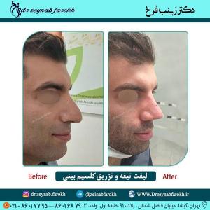 لیفت تیغه و تزریق کلسیم بینی 279