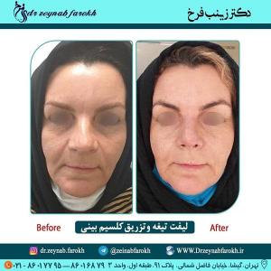 لیفت تیغه و تزریق کلسیم بینی 290