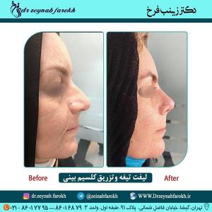 لیفت تیغه و تزریق کلسیم بینی 291