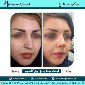 لیفت تیغه و تزریق کلسیم بینی 307
