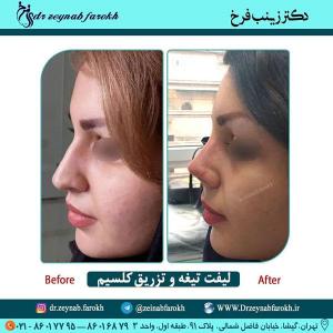 لیفت تیغه و تزریق کلسیم بینی 308