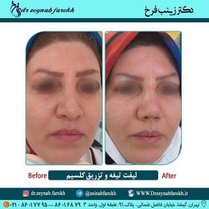لیفت تیغه و تزریق کلسیم بینی 312
