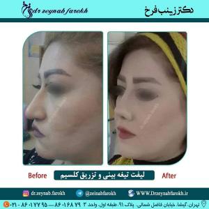 لیفت تیغه و تزریق کلسیم بینی 323