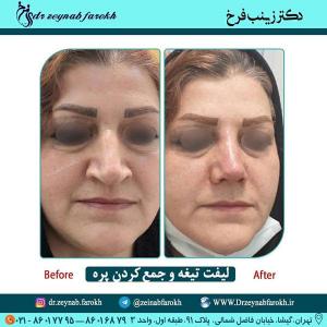 لیفت تیغه و جمع کردن پره 305