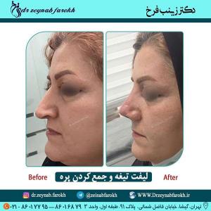 لیفت تیغه و جمع کردن پره 306