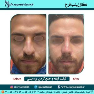 لیفت تیغه و جمع کردن پره بینی 261