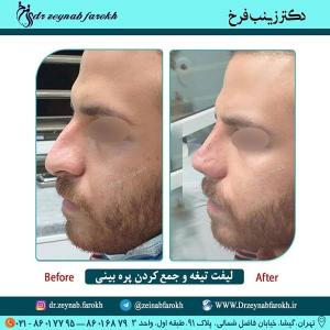 لیفت تیغه و جمع کردن پره بینی 263