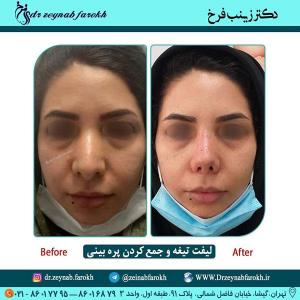 لیفت تیغه و جمع کردن پره بینی 288