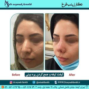 لیفت تیغه و جمع کردن پره بینی 289