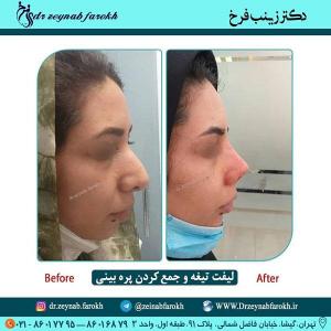 لیفت تیغه و جمع کردن پره بینی 290