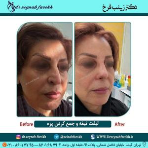 لیفت تیغه و جمع کردن پره بینی 298