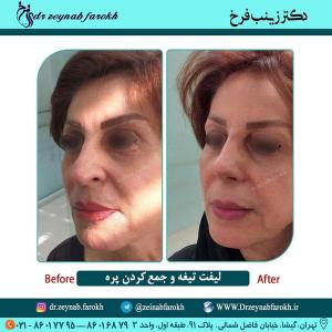 لیفت تیغه و جمع کردن پره بینی 299