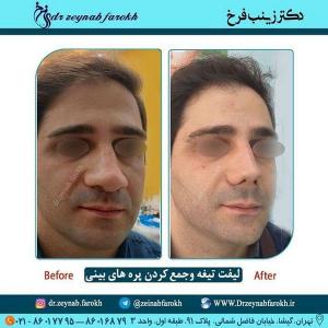 لیفت تیغه و جمع کردن پره های بینی 324