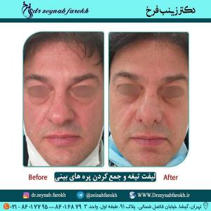 لیفت تیغه و جمع کردن پره های بینی 325