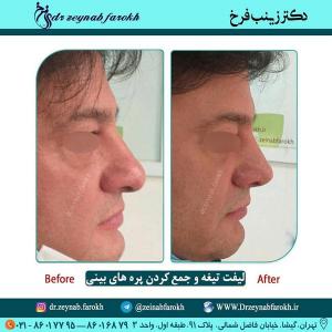 لیفت تیغه و جمع کردن پره های بینی 326