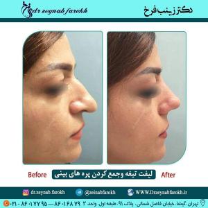 لیفت تیغه و جمع کردن پره های بینی 339