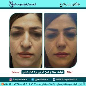 لیفت تیغه و جمع کردن پره های بینی 340