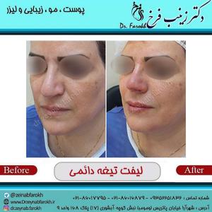 عکس  لیفت تیغه دائمی (1)