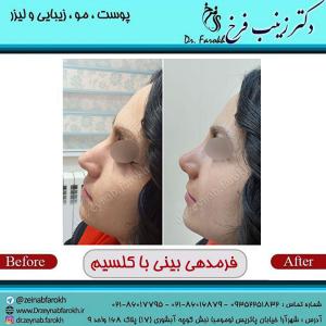 عکس فرم دهی بینی با کلسیم