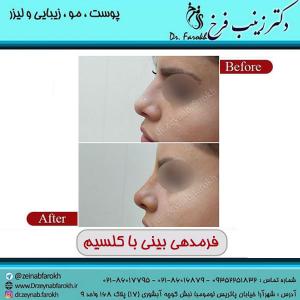 عکس فرمدهی بینی با کلسیم