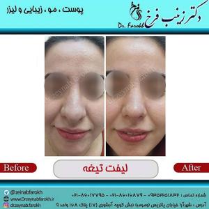 لیفت تیغه بینی
